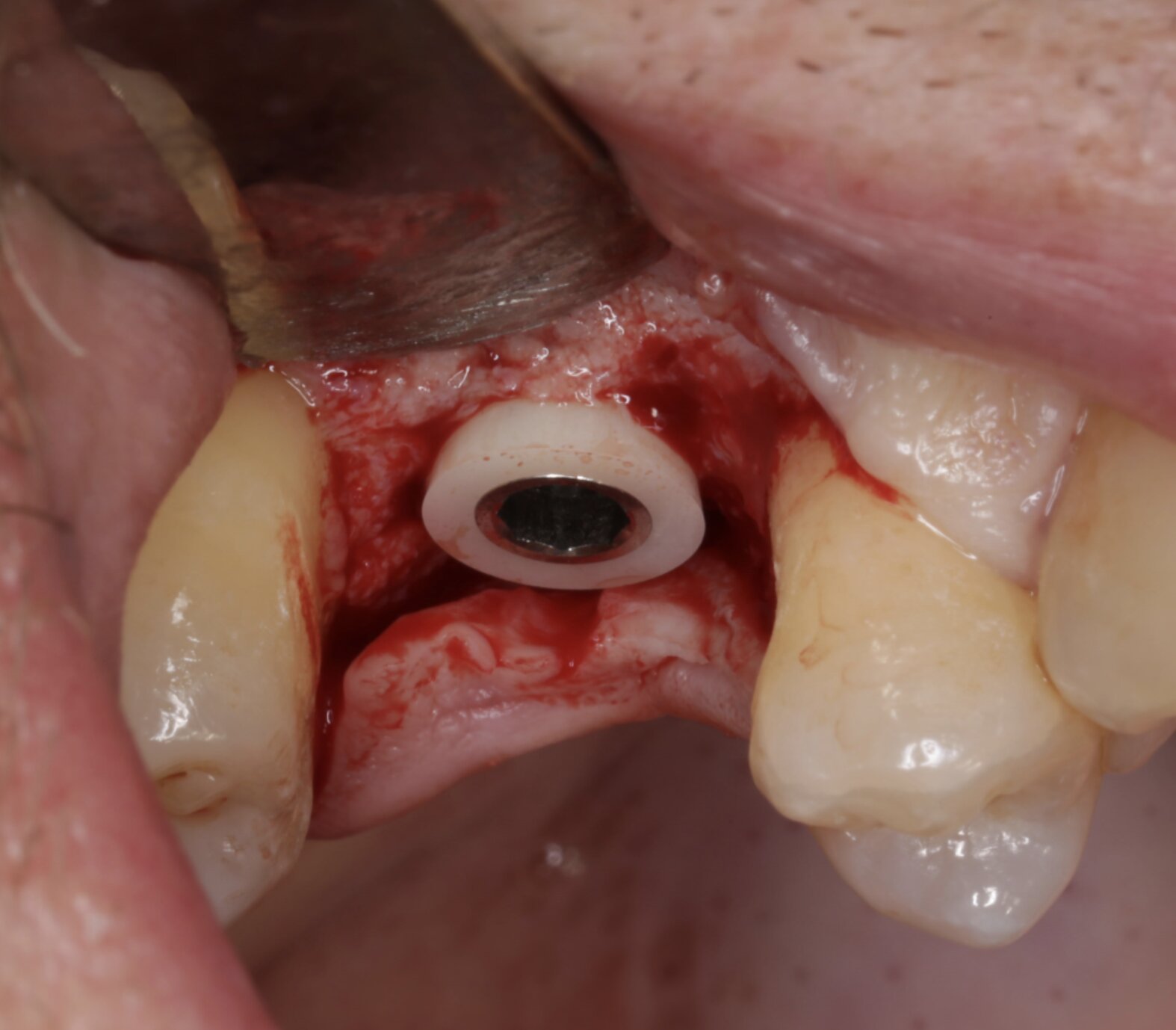 Z1 zirkonium kraag — klinisch beeld, occlusale weergave