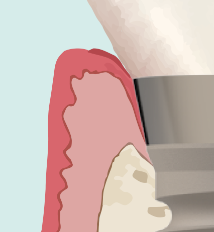 Grijs titanium — niet biomimetisch