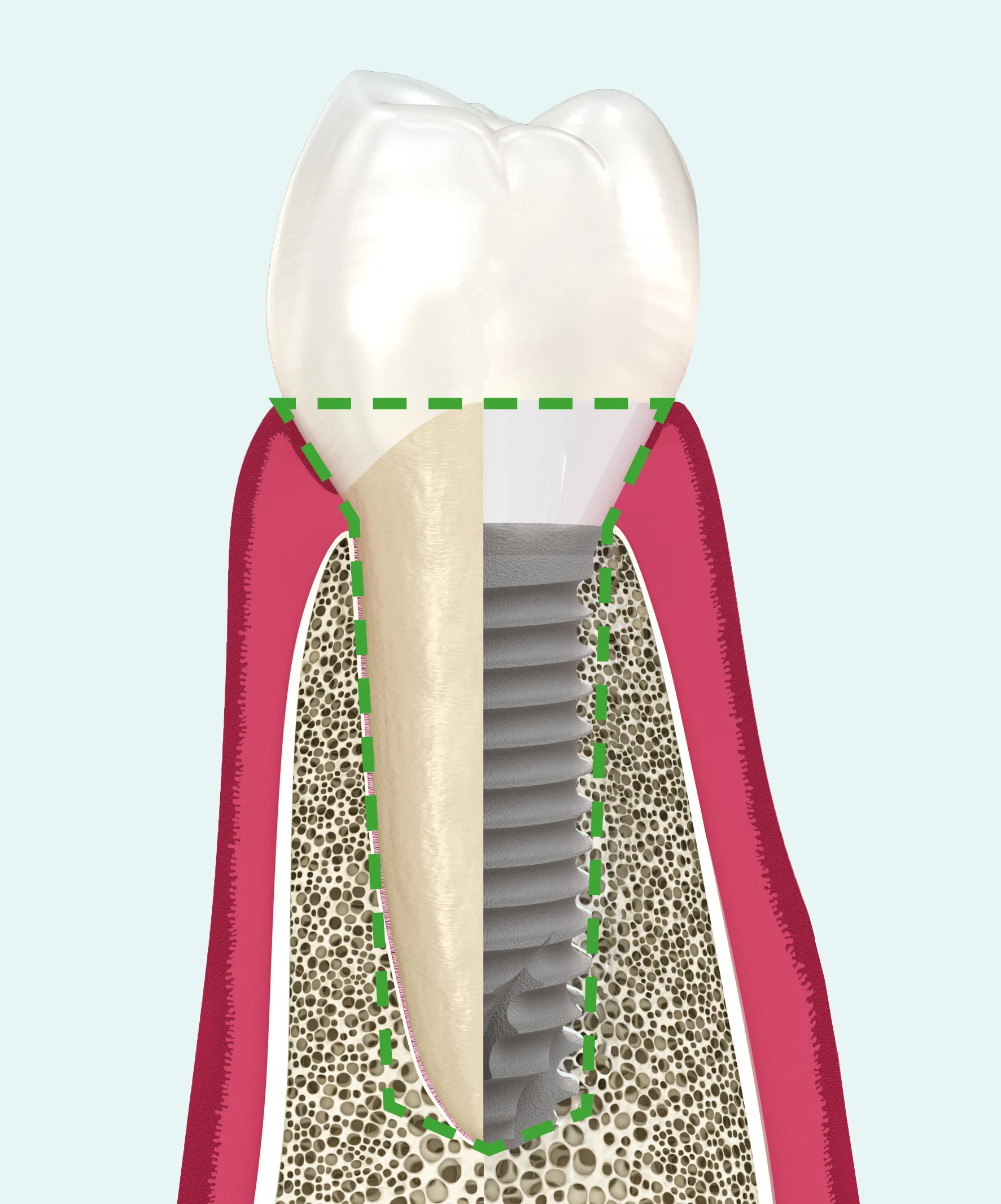 Biomimetisch emergence profile van de Z1 kraag