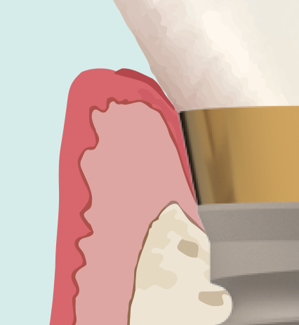 Goud titanium — niet biomimetisch