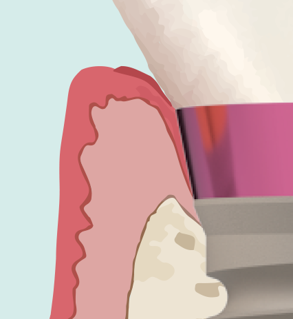 Roze titanium — niet biomimetisch