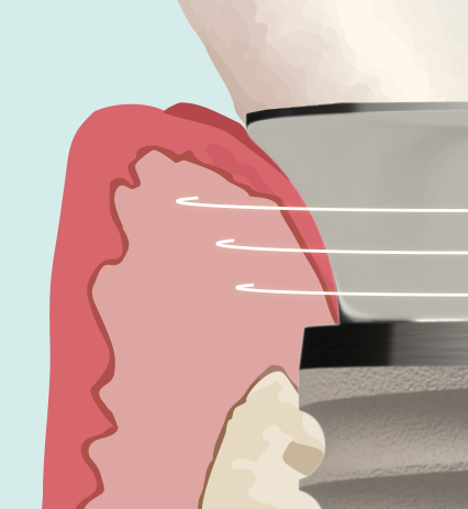 Titanium implantaat — niet biomimetisch