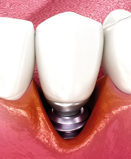 Peri-implantitis met botverlies