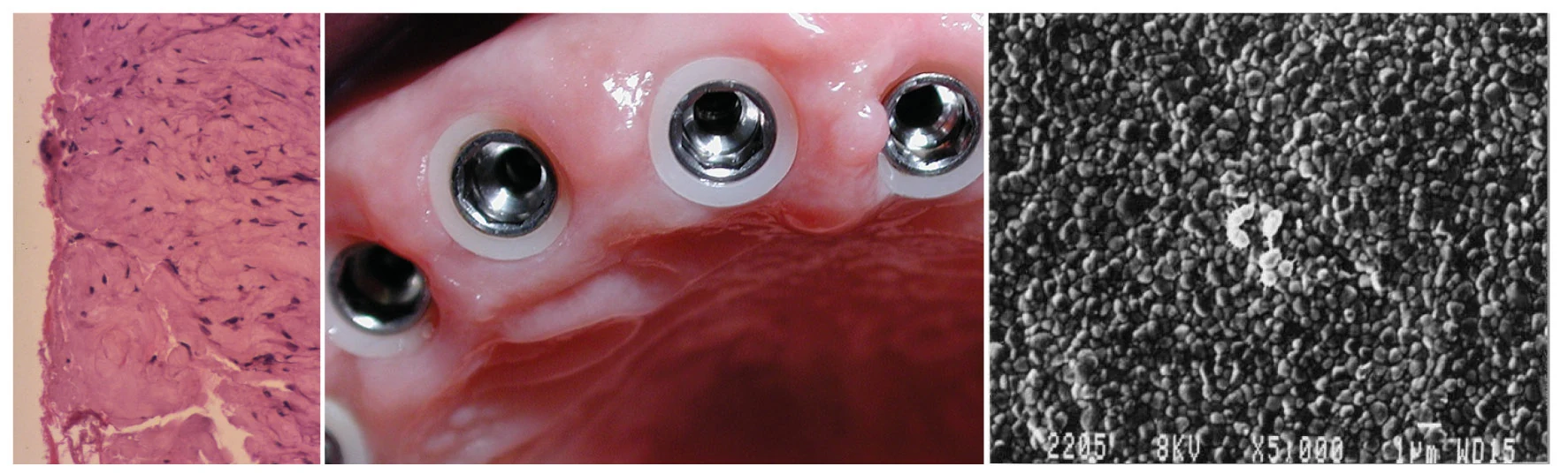 Zirkonium kraag — histologie, klinisch beeld en SEM-micrograaf